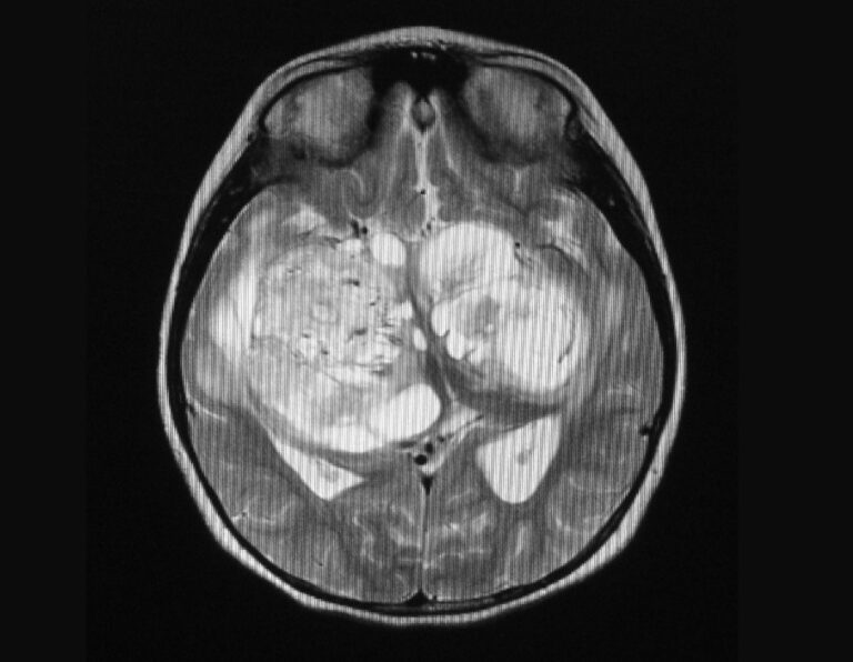 La primera vacuna para los tumores cerebrales malignos “es segura y eficaz”, según ensayo inicial