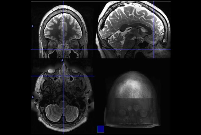 Nueva investigación relaciona a la rinosinusitis crónica con cambios en la actividad cerebral