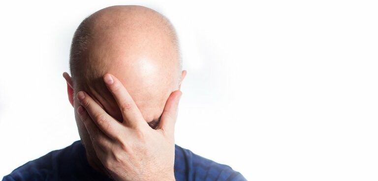 Un nuevo estudio sugiere una relación entre la calvicie y la gravedad del Covid-19