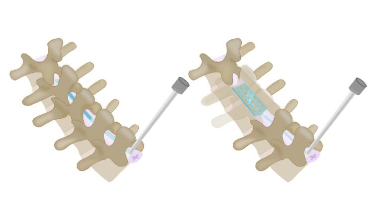 Científicos crean implantes espinales inflables que podrían ayudarnos a tratar el dolor crónico
