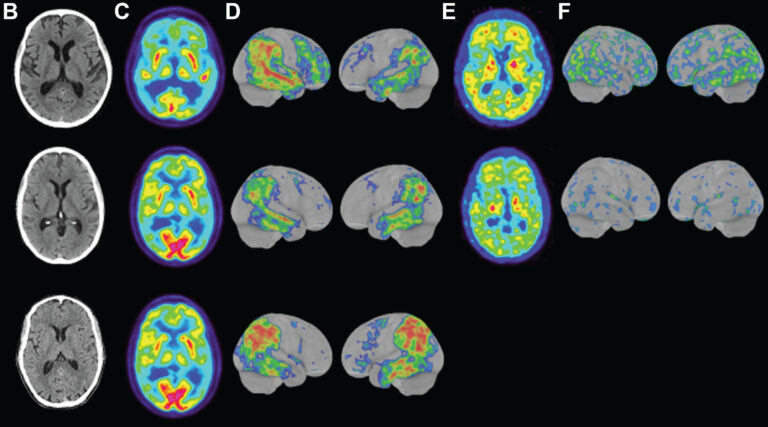 Científicos han identificado una forma rara y agresiva de Alzheimer que inicia a los 40 años de edad