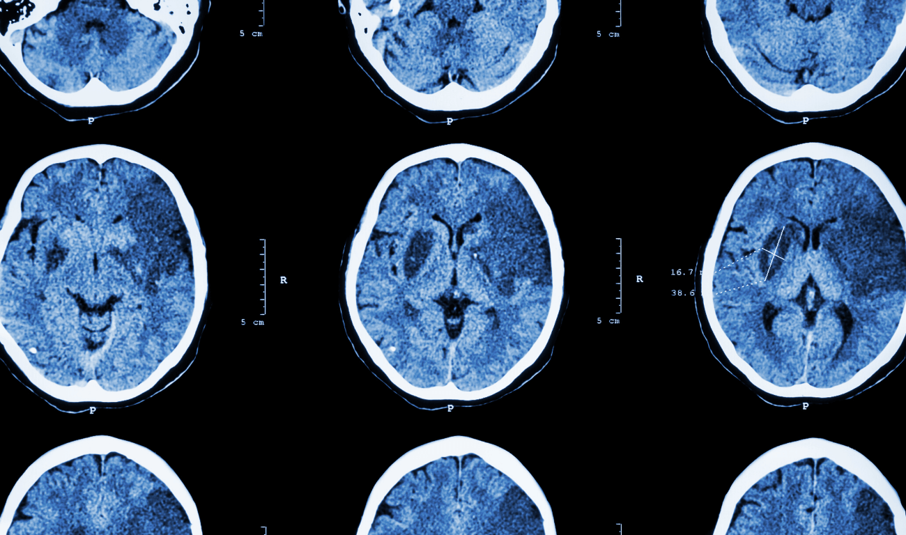 Una muestra de sangre puede revelar las posibilidades de recuperación luego de un traumatismo cerebral