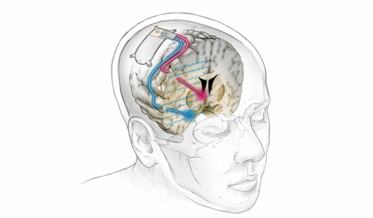 Científicos utilizan un implante cerebral para curar el trastorno depresivo resistente al tratamiento