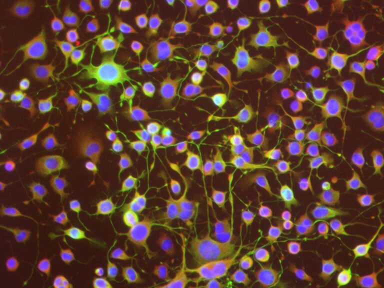 El Alzheimer no tendría su origen en el cerebro sino en el sistema inmune