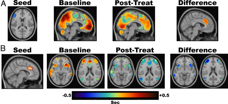 Científicos logran comprender porqué la estimulación cerebral es efectiva contra la depresión