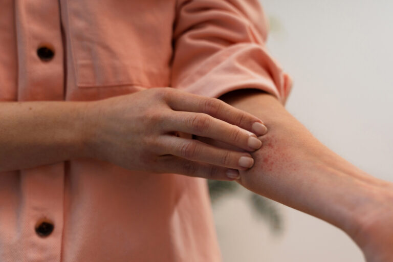 Identifican una bacteria como causante principal de la picazón en la dermatitis atópica