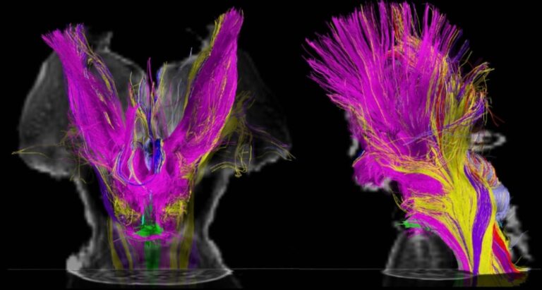 Estudio revolucionario destaca el papel del tronco encefálico en la conciencia humana