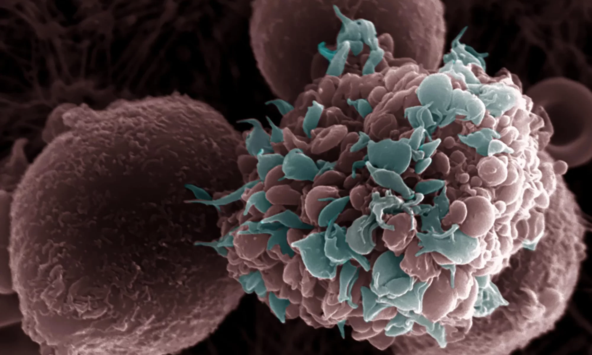 Nuevo estudio revela un vínculo alarmante entre la obesidad y el cáncer de mama