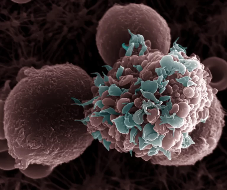 Nuevo estudio revela un vínculo alarmante entre la obesidad y el cáncer de mama