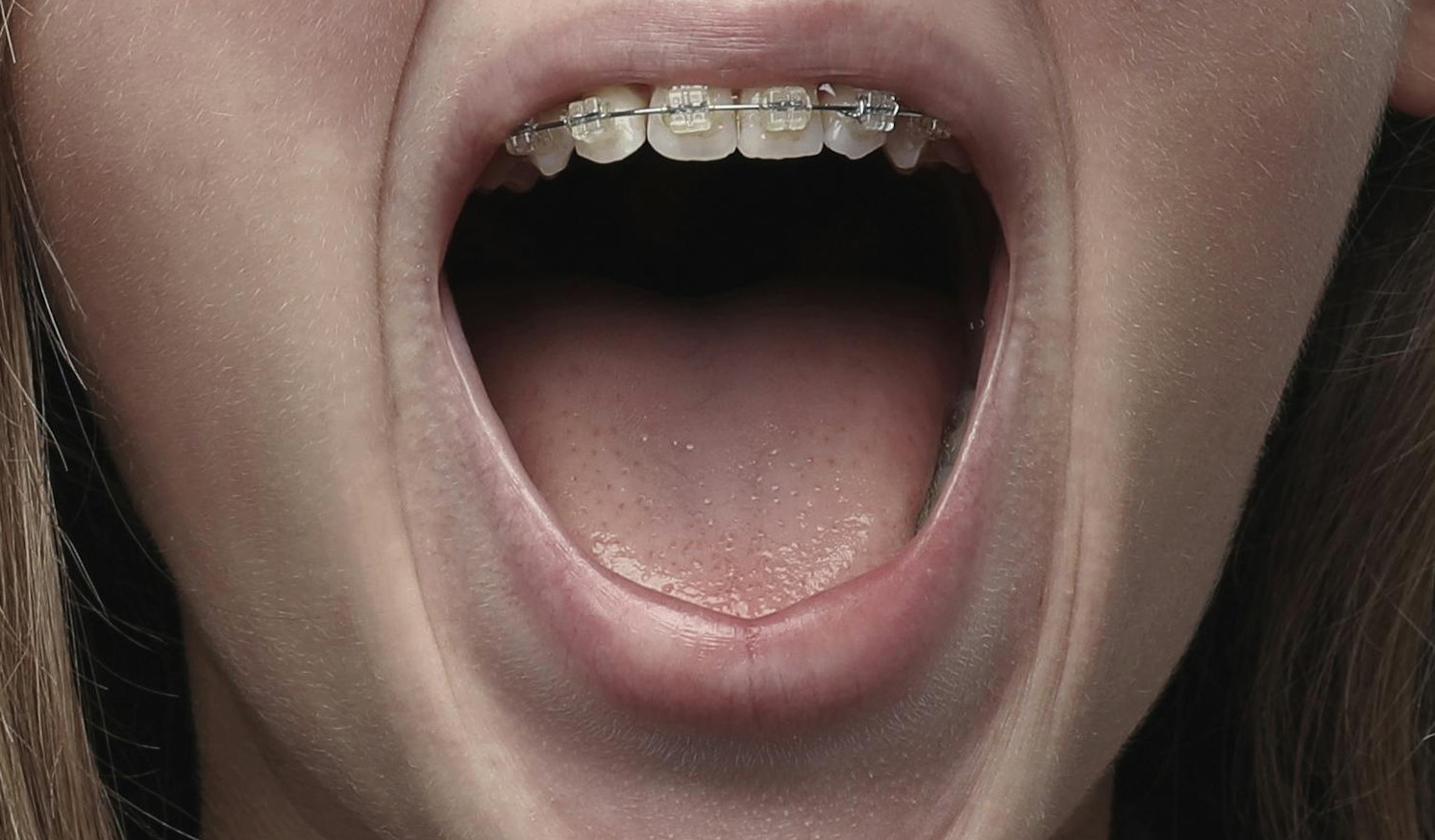 Las bacterias de tu propia boca podrían provocarte un ataque cardíaco, sugiere un nuevo estudio