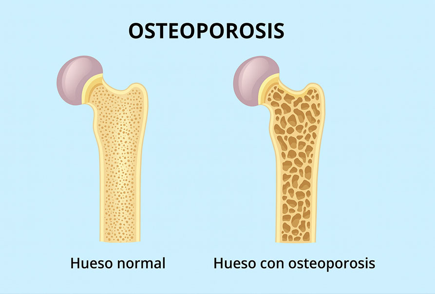 Un nuevo avance para fortalecer los huesos podría revertir la osteoporosis