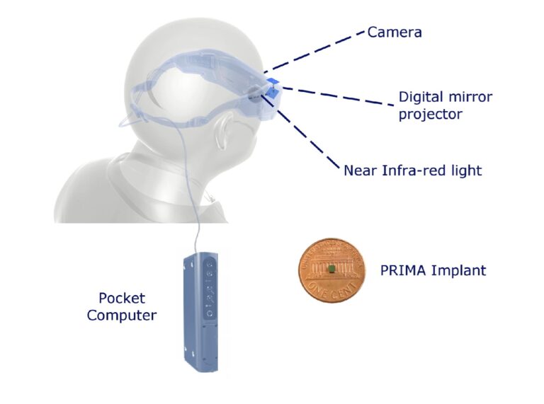 Investigadores inventan un implante de retina que permite enfocar la vista  