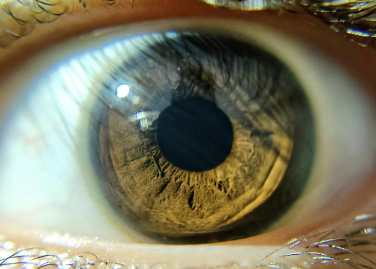 Un estudio revela que tus ojos podrían delatar tu riesgo de osteoporosis